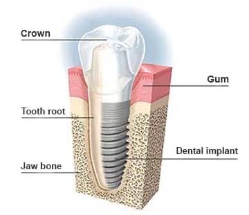 What Are Dental Implants?