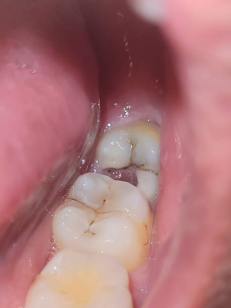 Wisdom Tooth Surgery in Ahmedabad