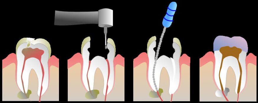 root canal in kids
