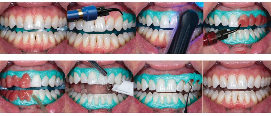 Teeth whitening in ahmedabad