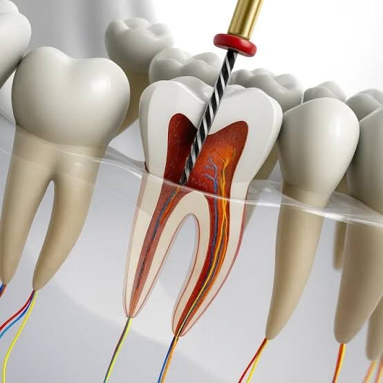 What is Root Canal Treatment?